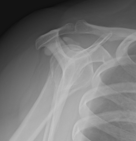 Calcific Tendonits Lateral